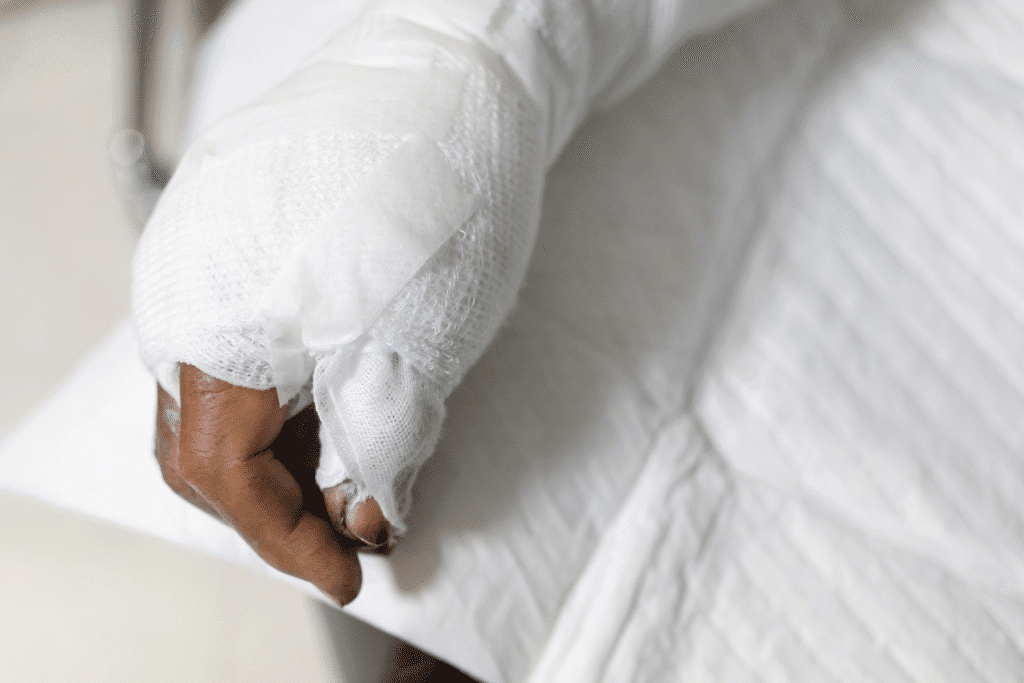 Burn victim’s bandaged hand after injury in Scottsdale hospital