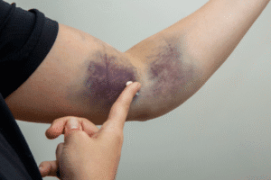 Severe internal bruising on forearm after accident in Arizona