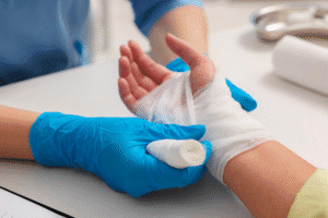 Medical professional bandaging a patient’s burned hand after injury, illustrating burn injury treatment and recovery in Phoenix, Arizona.